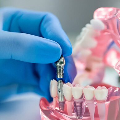 model showing dental implant