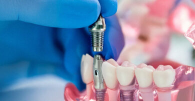 model showing dental implant