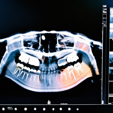 cbct scan of teeth