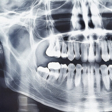 Teeth Xray